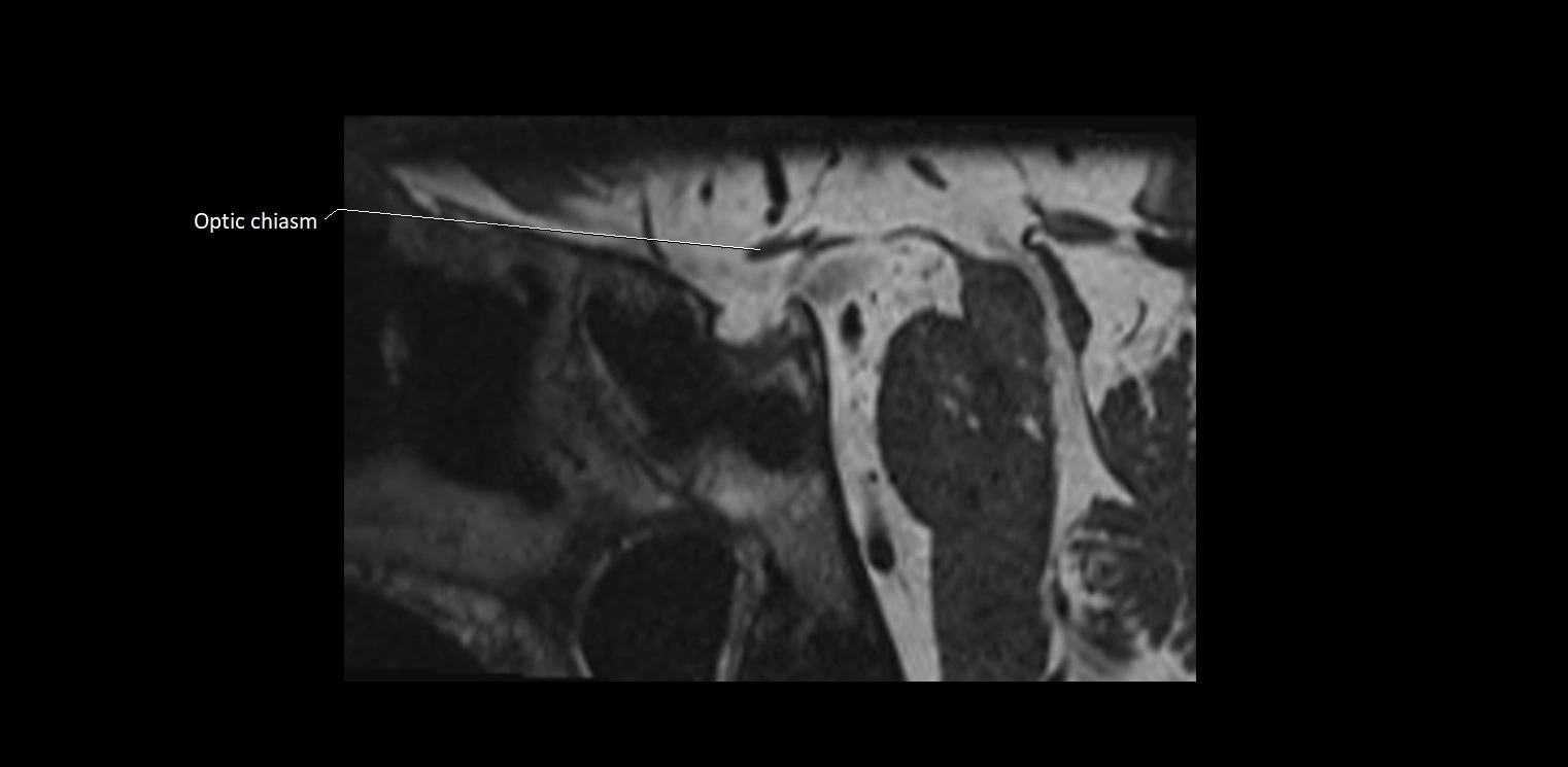 Cranial nerve sagittal anatomy MRI 3T image 32.webp